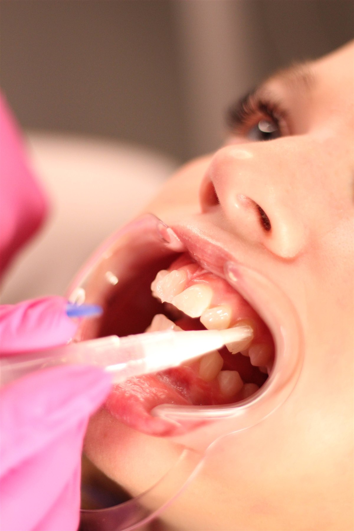 Whitening gel being applied tooth by tooth before the light
